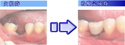 image-implant1