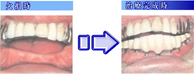 image-implant2