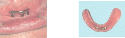 image-implant3